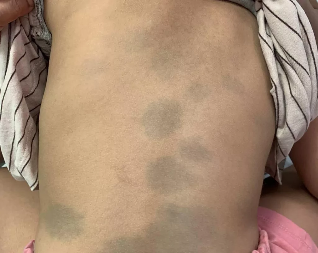 Mongolian Blue Spots Meaning: A Parent’s Guide Mongolian Blue Spots Meaning