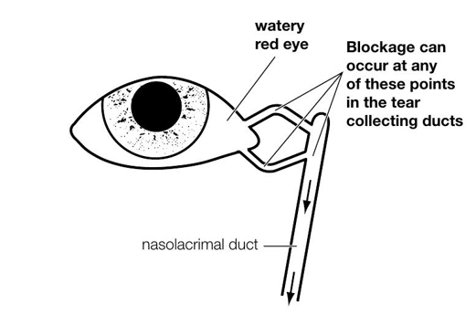 Tear Duct Blockage in Babies: A Common Concern in the Clinic Tear Duct Blockage in Babies: A Common Concern in the Clinic