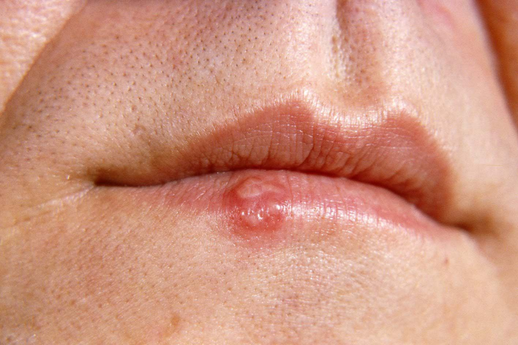 Understanding Cold Sores (Herpes Simplex): Causes, Symptoms, and Management Understanding Cold Sores (Herpes Simplex): Causes, Symptoms, and Management