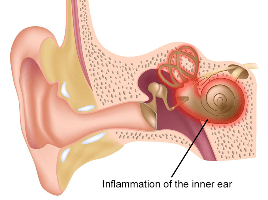 Understanding Labyrinthitis: A Visit to the Community Health Center Understanding Labyrinthitis: A Visit to the Community Health Center