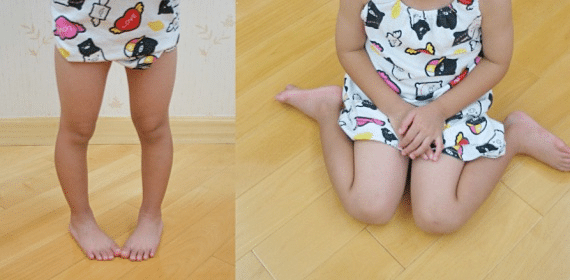 Intoeing in Children: A Parent’s Guide to Pigeon Toes