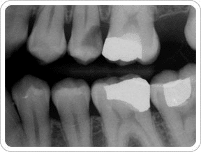 Tooth Crown Before and After: Witnessing the Transformation of Your Smile molar crown before and after x-ray