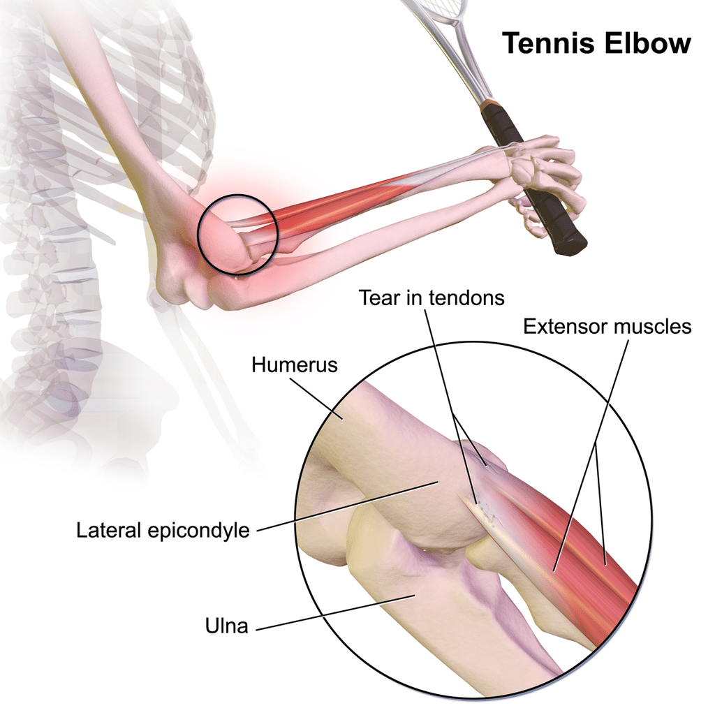 Understanding Tennis Elbow: A Common But Manageable Condition Understanding Tennis Elbow: A Common But Manageable Condition