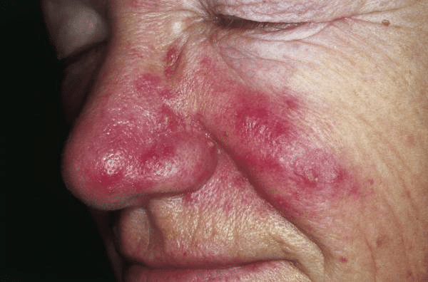 Understanding Rosacea: Lisa’s Journey to Confidence acne rosacea