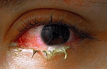 Understanding Conjunctivitis: Causes, Symptoms, and Treatment