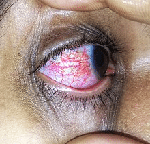 Understanding Conjunctivitis: Causes, Symptoms, and Treatment
