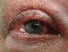 Understanding Conjunctivitis: Causes, Symptoms, and Treatment