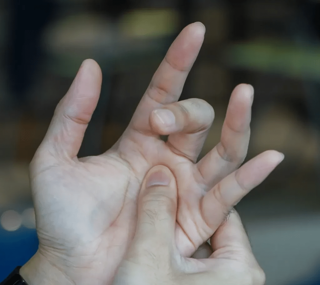 Trigger Finger: What You Need to Know About This Common Hand Condition Trigger Finger: What You Need to Know About This Common Hand Condition